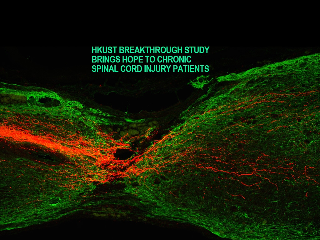 嶄新科學治療為慢性脊髓損傷患者帶來希望