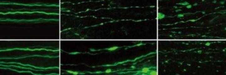 Parkinson’s and ALS
