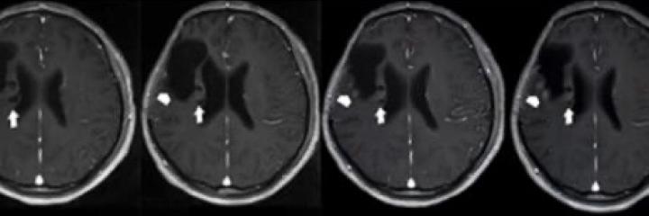 Brain scan seeing signs of cancer